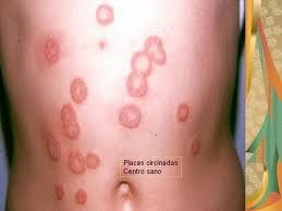 que es la infeccion micotica